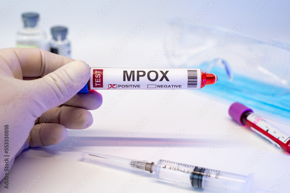 Fototapeta premium Blood collection tubes monkeypox （MPOX） test positive results