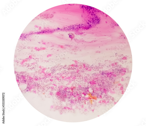 Paps smear under microscopy showing inflammatory smear with hpv related changes. Cervical cancer. SCC