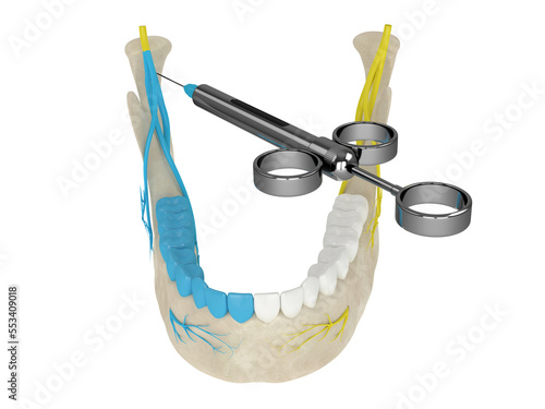 3d render of mandibular arch with gow-gates nerve block photo