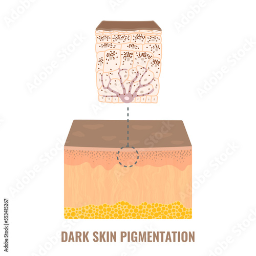 Melanin content and distribution in dark skin phototype. Pigmentation mechanism infographic diagram. Epidermis cross-section in closeup. Vector illustration. photo