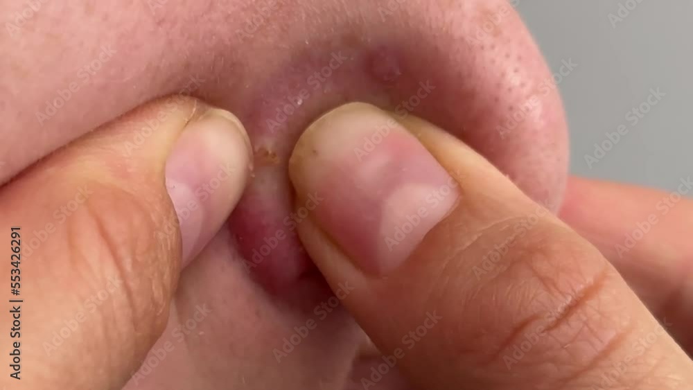 Cropped shot of teenager squeezing red inflamed pimple on nose, acne problems, comedones, concept of cosmetic dermatology and age related hormonal changes, pus and blood squeezed out of pimple. Cropped shot of teenager squeezing red inflamed pimple on nose, acne problems, comedones, concept of cosmetic dermatology and age related hormonal changes, pus and blood squeezed out of pimple.