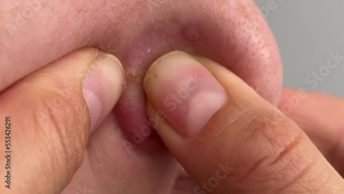 Cropped shot of teenager squeezing red inflamed pimple on nose, acne problems, comedones, concept of cosmetic dermatology and age related hormonal changes, pus and blood squeezed out of pimple. photo