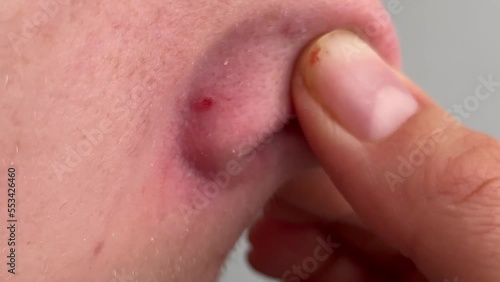 Cropped shot of teenager squeezing red inflamed pimple on nose, acne problems, comedones, concept of cosmetic dermatology and age related hormonal changes, pus and blood squeezed out of pimple. photo