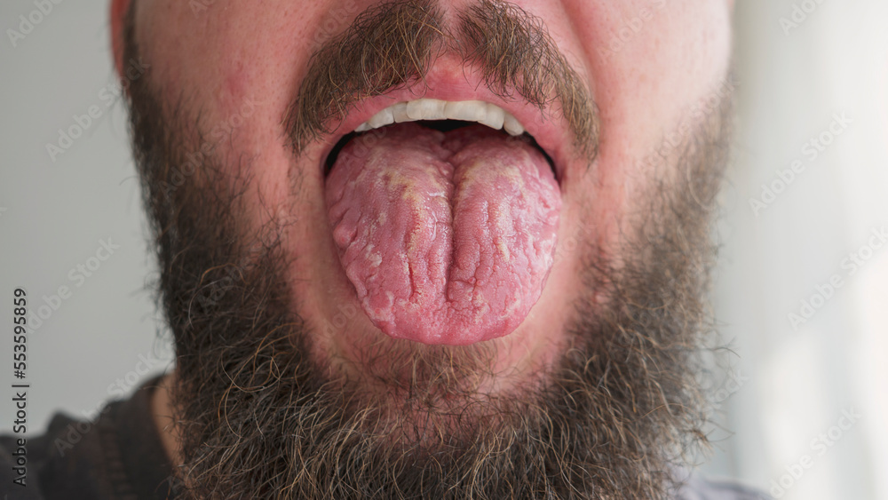 foto-stock-geographic-tongue-disease-candidiasis-tongue-inflammatory