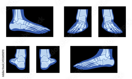 Set of X-Ray Foot Legs Skeleton Human body Bones adult people roentgen front back side view. 3D realistic flat blue color concept Vector illustration of medical anatomy isolated on black background
