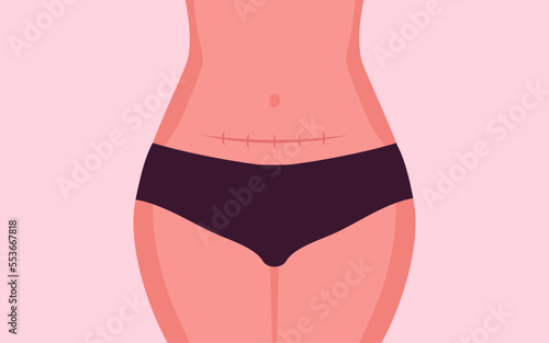 Woman Showing Belly with Stitches from Cesarean Section Surgery operation with Vertical scar photo