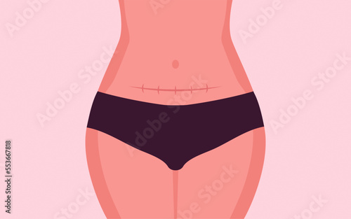 Woman Showing Belly with Stitches from Cesarean Section Surgery operation with Vertical scar