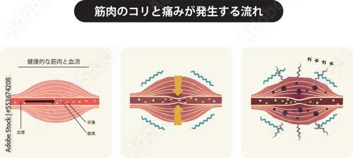 筋肉と血流の断面図と筋肉のコリと痛みが発生する仕組みと流れ