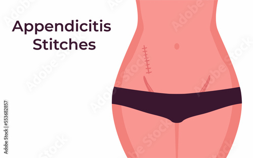 Woman Showing Belly with Stitches from Appendectomy Surgery, appendix scar vector illustration.