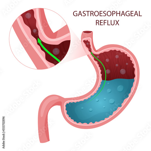 Gastroesophageal reflux disease diagram. Detailed illustration.