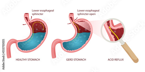 Healthy stomach and GERD infographic