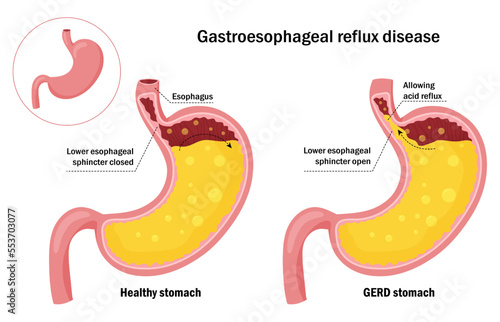 Healthy stomach and gastroesophageal reflux disease infographic