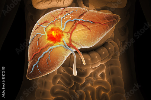 Liver cancer, Hepatocellular Carcinoma (HCC), conditions, causes and treatment. 3d illustration