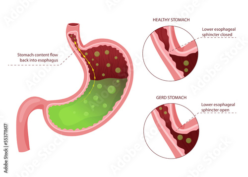 Gastroesophageal reflux disease diagram. Moving gastric juice to esophagus through opened esophageal sphincter, making heartburn. Detailed illustration. Cartoon design.
