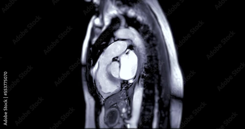 MRI heart or Cardiac MRI ( magnetic resonance imaging ) of heart in ...