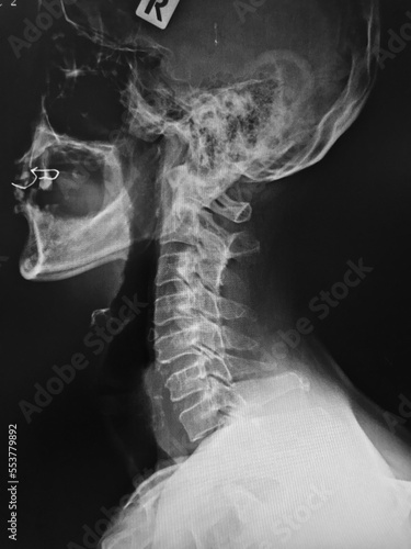 x ray image of spine