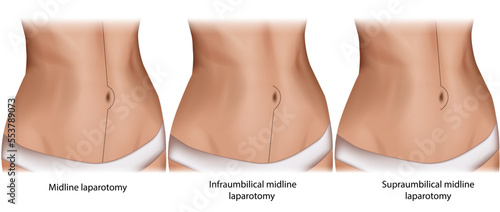Abdominal midline incision. Incision sites for types of midline laparotomies. Midline laparotomy, Infraumbilical and Supraumbilical midline laparotomy. photo