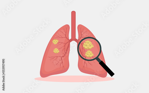 Illustration of a malignant tumor. lung cancer. concept of reparatory disease. vector illustration