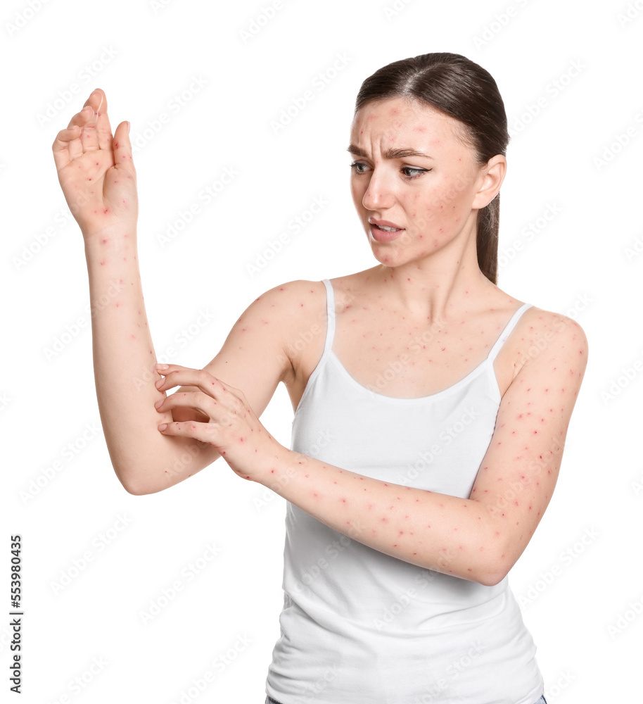 Woman with rash suffering from monkeypox virus on white background Woman with rash suffering from monkeypox virus on white background