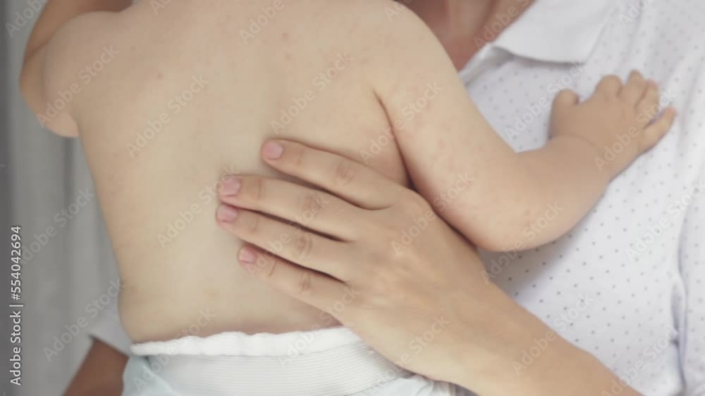 mother holding in arms little baby boy child toddler infant rock from side to side.sleeping child rubbing rubs eye with little cute hand rush allergy over body on neck back.infant in diaper summertime mother holding in arms little baby boy child toddler infant rock from side to side.sleeping child rubbing rubs eye with little cute hand rush allergy over body on neck back.infant in diaper summertime
