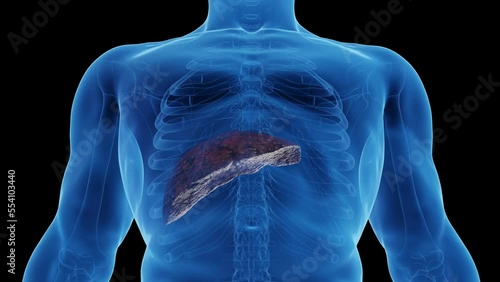 3D medical animation of a man's cirrhotic liver photo