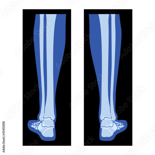 X-Ray Foot Legs Skeleton, Fibula, Tibia - Phalanges Human body, Bones adult people roentgen back view. 3D flat blue color concept Vector illustration of medical anatomy isolated on black background