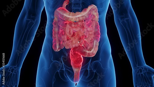 3D medical animation of a man's intestines affected by crohn's disease