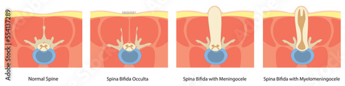 Spina Bifida illustration in a Cross view. normal spine, meningocele and meningomyelocele