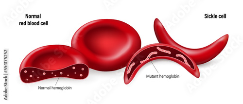 Sickle cell disease. Normal red blood cells and sickled red blood cells. Normal hemoglobin and mutant hemoglobin. photo