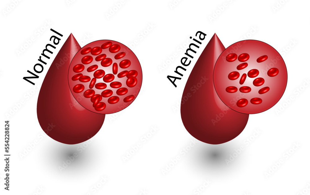 Iron deficiency anemia. The difference of Anemia amount of red blood