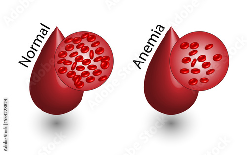 Iron deficiency anemia. The difference of Anemia amount of red blood cell and normal. Blood droplet. Blood donation. Realistic vector 3d picture. Vector illustration isolated on white background.