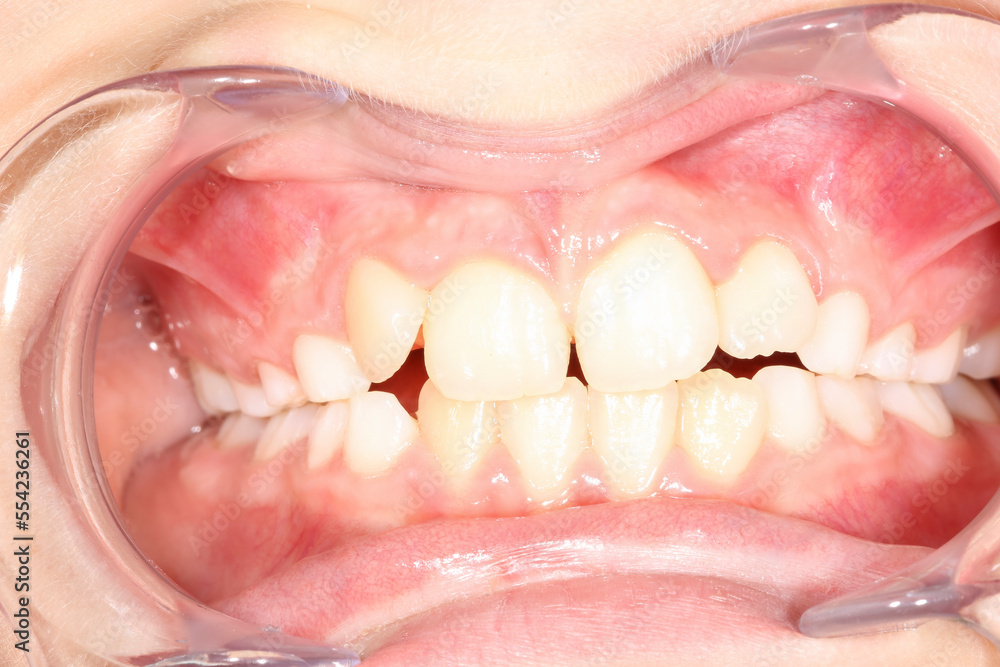 Intra-oral picture of teeth and gum in the smile mouth oral care. Bacteria, dental plaque is the cause of gingivitis and tooth decayed. Opener mouth used by dentist.
