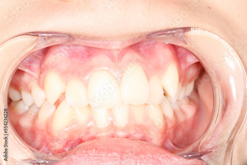 Intra-oral picture of teeth and gum in the smile mouth oral care. Bacteria, dental plaque is the cause of gingivitis and tooth decayed. Opener mouth used by dentist.