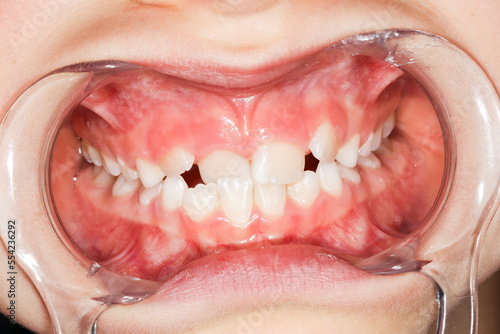 Intra-oral picture of teeth and gum in the smile mouth oral care. Bacteria, dental plaque is the cause of gingivitis and tooth decayed. Opener mouth used by dentist.