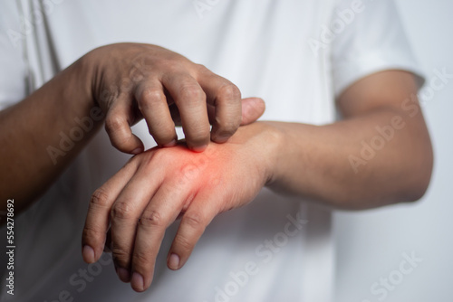 Man scratching his hand. Medical concept.