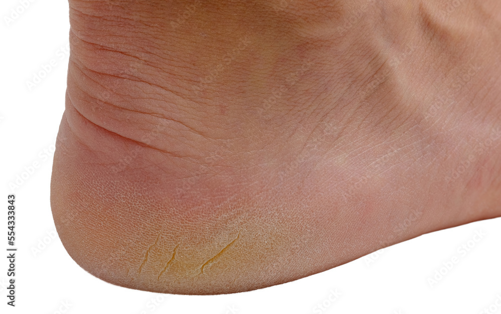Fototapeta premium a foot on the white background with a cracked heel