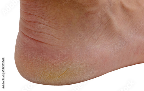 a foot on the white background with a cracked heel