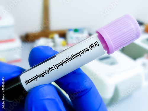 Blood sample for HLH or Hemophagocytic Lymphohistiocytosis, a rare fatal condition in which white blood cells damage organs, including bone marrow, liver, spleen. photo