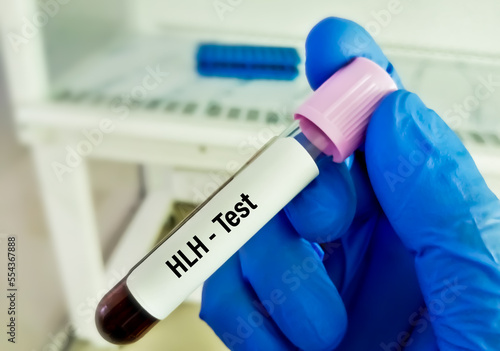 Blood sample for HLH or Hemophagocytic Lymphohistiocytosis, a rare fatal condition in which white blood cells damage organs, including bone marrow, liver, spleen. photo