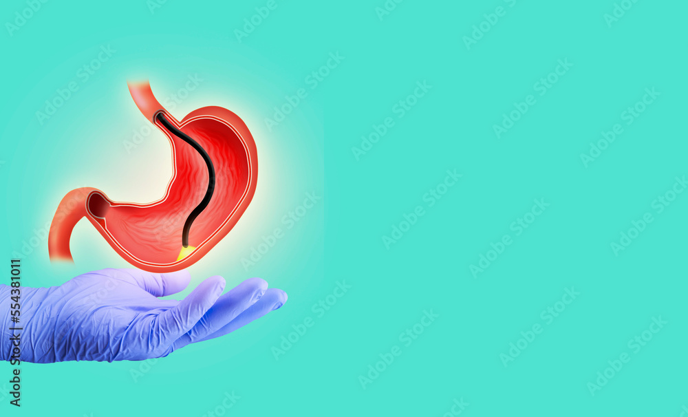 Endoscopic biopsy, esophagogastroduodenoscopy, EGD. Human stomach