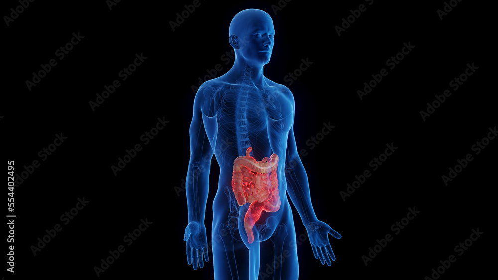 3D medical illustration of a man's intestines affected by Crohn's disease 3D medical illustration of a man's intestines affected by Crohn's disease