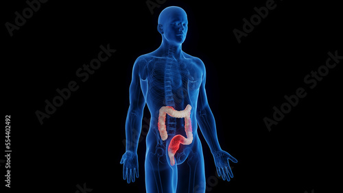Plakat w ramie 3D medical illustration of a man's inflamed colon