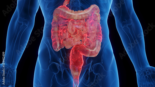 Fotografering 3D medical illustration of a man's intestines affected by Crohn's disease