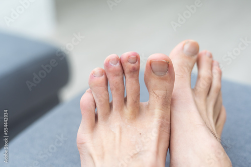 man toes with hair and dirty toenails.