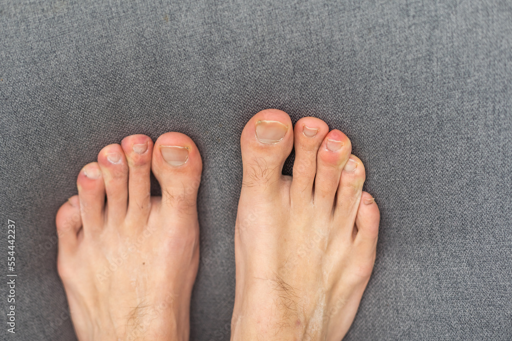 Fototapeta premium man toes with hair and dirty toenails.