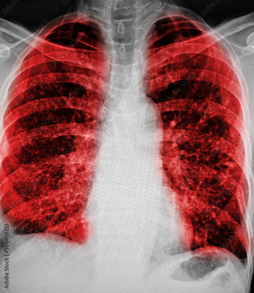 Foto de Bronchiectasis . Xray chest show multiple lung do Stock