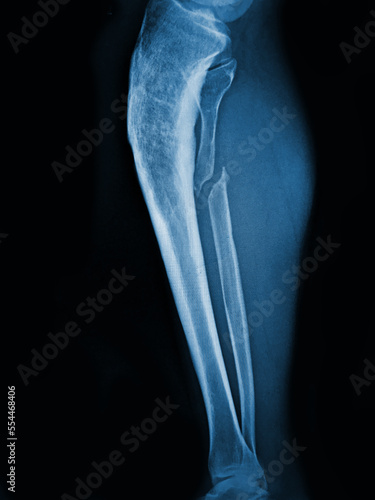 X-ray human fibula fracture Lateral view