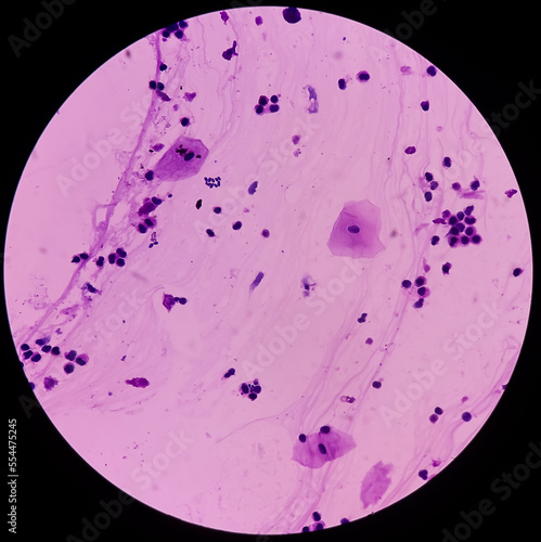 Photomicrograph of urine microscopy, urine cytology, Pap stain. Shows epithelial cells, neutrophils and occasional histiocytes.