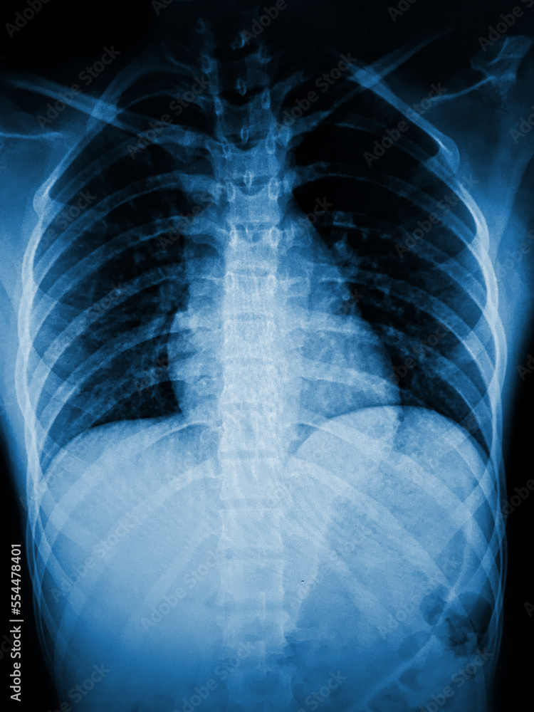 x ray image of chest x ray image of chest