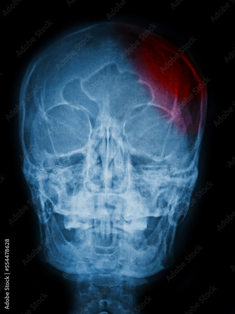x ray of human skull x ray of human skull